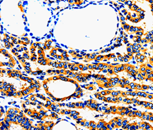 Immunohistochemistry of paraffin-embedded Human thyroid cancer using AIMP2 Polyclonal Antibody at dilution of 1:50