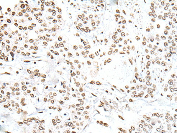 Immunohistochemistry of paraffin-embedded Human prost ate cancer tissue  using SNRPA Polyclonal Antibody at dilution of 1:30(?200)