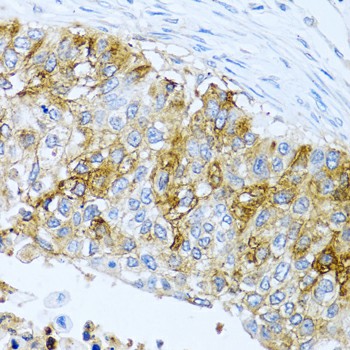 Immunohistochemistry of paraffin-embedded human lung cancer using IFIT3 Polyclonal Antibody at dilution of 1:100 (40x lens).Perform microwave antigen retrieval with 10 mM PBS buffer pH 7.2 before commencing with IHC staining protocol.