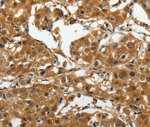 Immunohistochemistry of paraffin-embedded Human lung cancer tissue using AKAP12 Polyclonal Antibody at dilution 1:40