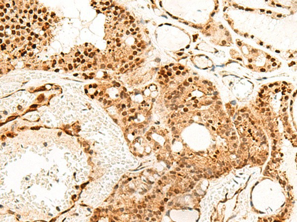 Immunohistochemistry of paraffin-embedded Human thyroid cancer tissue  using PDCD4 Polyclonal Antibody at dilution of 1:35(?200)