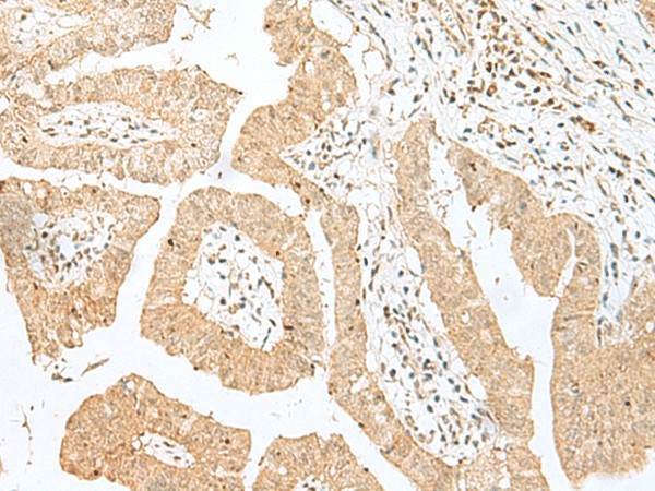 Immunohistochemistry of paraffin-embedded Human liver cancer tissue  using BEX2 Polyclonal Antibody at dilution of 1:50(?200)