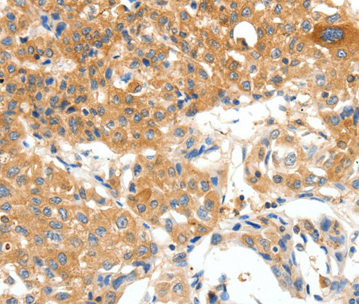 Immunohistochemistry of paraffin-embedded Human lung cancer using PLAT Polyclonal Antibody at dilution of 1:50