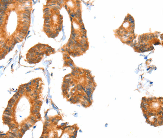 Immunohistochemistry of paraffin-embedded Human colon cancer tissue using ACOX1 Polyclonal Antibody at dilution 1:40