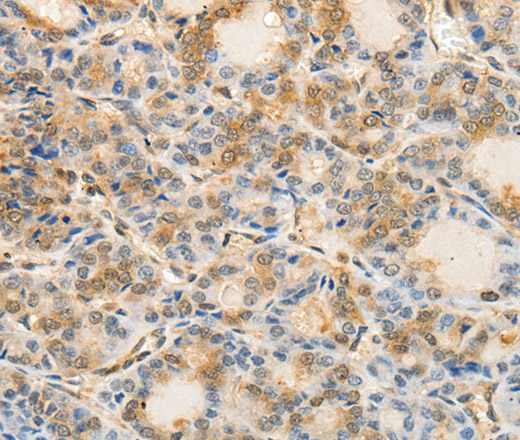 Immunohistochemistry of paraffin-embedded Human thyroid cancer tissue using Otocadherin Polyclonal Antibody at dilution 1:60