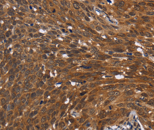 Immunohistochemistry of paraffin-embedded Human cervical cancer using FHIT Polyclonal Antibody at dilution of 1:30