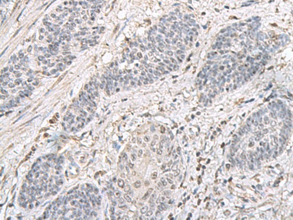 Immunohistochemistry of paraffin-embedded Human esophagus cancer tissue  using EPM2A Polyclonal Antibody at dilution of 1:75(?200)