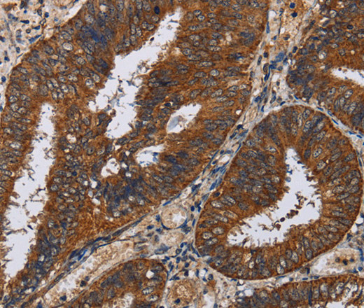 Immunohistochemistry of paraffin-embedded Human colon cancer tissue using KLK11 Polyclonal Antibody at dilution 1:50