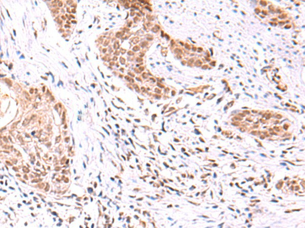 Immunohistochemistry of paraffin-embedded Human esophagus cancer tissue  using TRMT12 Polyclonal Antibody at dilution of 1:80(?200)