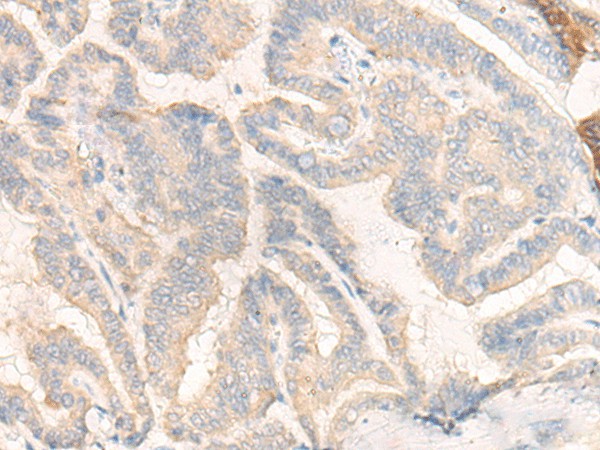 Immunohistochemistry of paraffin-embedded Human thyroid cancer tissue  using COG4 Polyclonal Antibody at dilution of 1:30(?200)