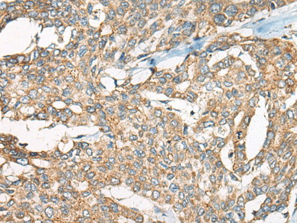 Immunohistochemistry of paraffin-embedded Human liver cancer tissue  using YEATS2 Polyclonal Antibody at dilution of 1:55(?200)