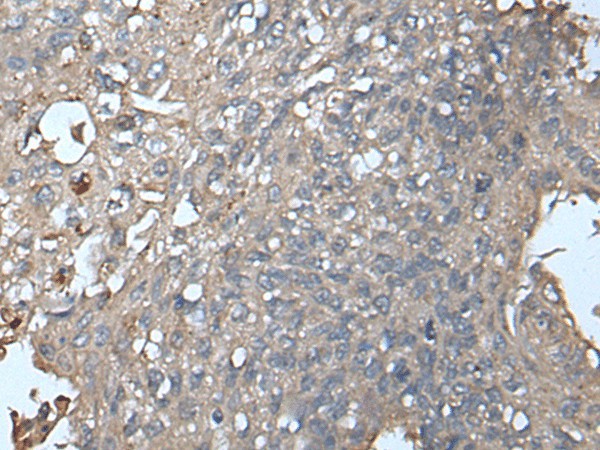 Immunohistochemistry of paraffin-embedded Human lung cancer tissue  using UNC13B Polyclonal Antibody at dilution of 1:85(?200)