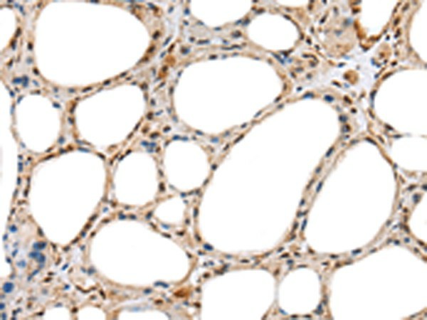 Immunohistochemistry of paraffin-embedded Human thyroid cancer tissue  using RAB11A Polyclonal Antibody at dilution of 1:35(?200)