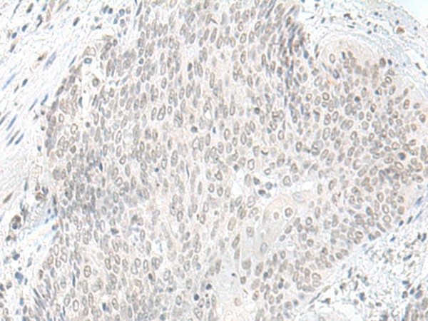 Immunohistochemistry of paraffin-embedded Human esophagus cancer tissue  using ORC1 Polyclonal Antibody at dilution of 1:65(?200)