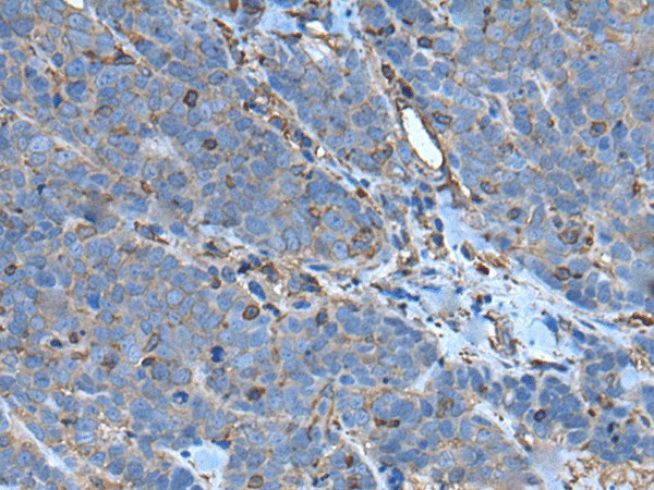 Immunohistochemistry of paraffin-embedded Human thyroid cancer tissue  using SLC24A5 Polyclonal Antibody at dilution of 1:50(?200)