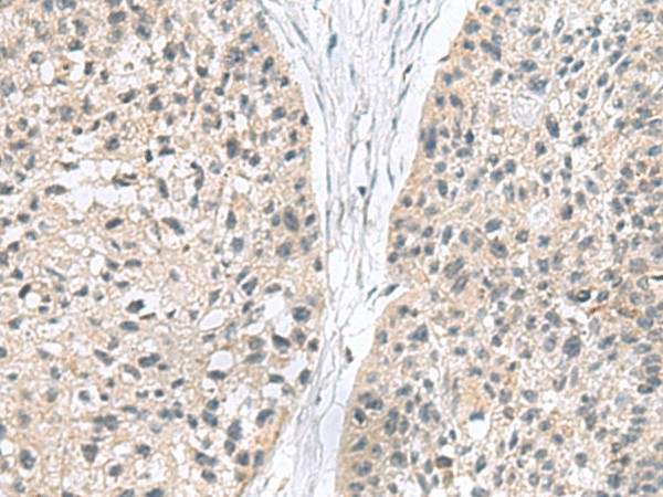 Immunohistochemistry of paraffin-embedded Human esophagus cancer tissue  using MIA Polyclonal Antibody at dilution of 1:180(?200)