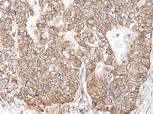 Immunohistochemistry of paraffin-embedded Human gastric cancer tissue  using RNF111 Polyclonal Antibody at dilution of 1:50(?200)