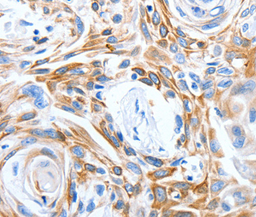 Immunohistochemistry of paraffin-embedded Human esophagus cancer tissue using LRIG3 Polyclonal Antibody at dilution 1:50