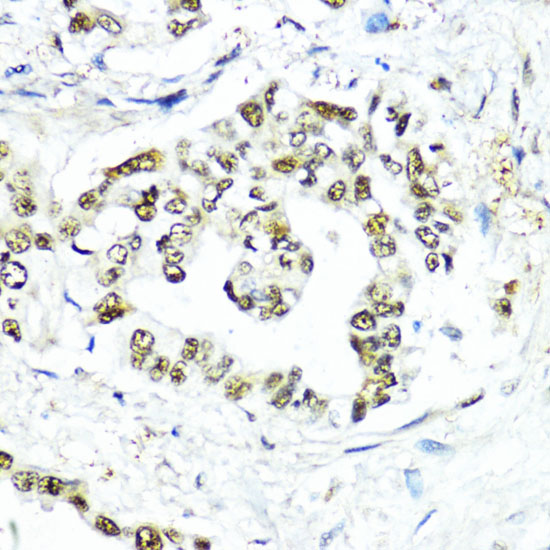 Immunohistochemistry of paraffin-embedded human lung cancer using SUMO1 Polyclonal Antibody at dilution of 1:200 (40x lens).Perform microwave antigen retrieval with 10 mM PBS buffer pH 7.2 before commencing with IHC staining protocol.