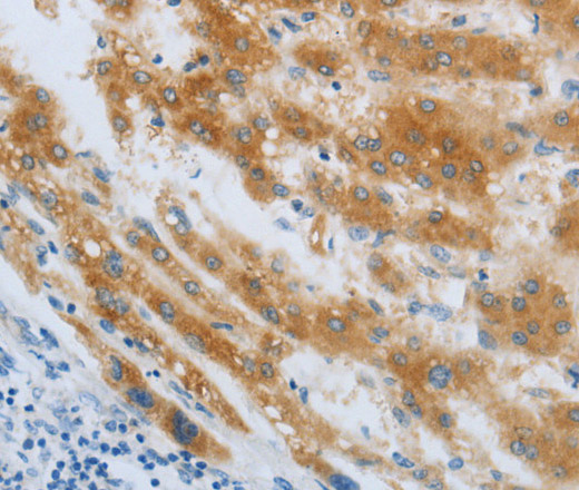 Immunohistochemistry of paraffin-embedded Human liver cancer using CHRNA7 Polyclonal Antibody at dilution of 1:40