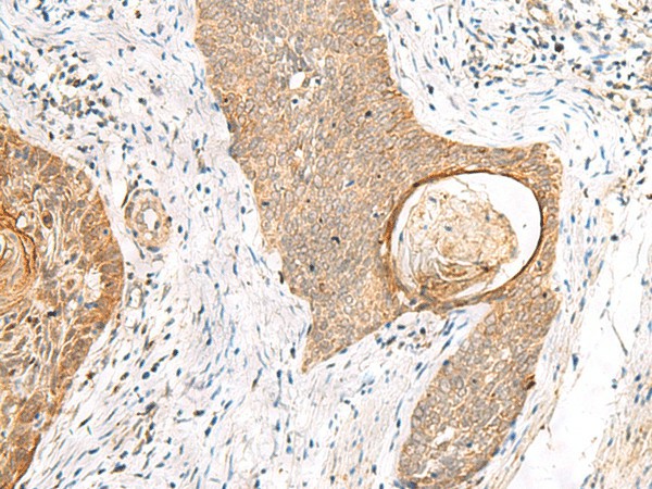 Immunohistochemistry of paraffin-embedded Human esophagus cancer tissue  using TOR1A Polyclonal Antibody at dilution of 1:35(?200)