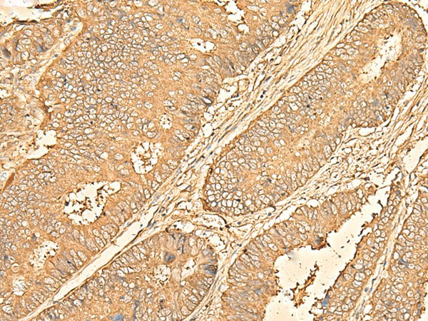 Immunohistochemistry of paraffin-embedded Human colorectal cancer tissue  using RPS28 Polyclonal Antibody at dilution of 1:30(?200)