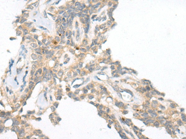 Immunohistochemistry of paraffin-embedded Human ovarian cancer tissue  using CAMK2A Polyclonal Antibody at dilution of 1:55(?200)