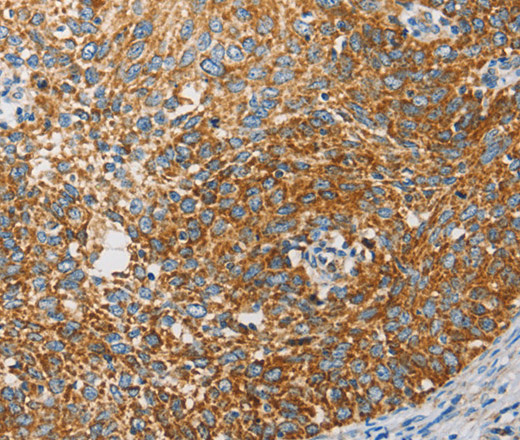 Immunohistochemistry of paraffin-embedded Human cervical cancer tissue using APOBEC3G Polyclonal Antibody at dilution 1:50