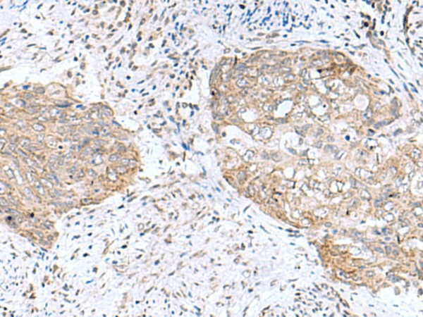 Immunohistochemistry of paraffin-embedded Human cervical cancer tissue  using PAM16 Polyclonal Antibody at dilution of 1:50(?200)