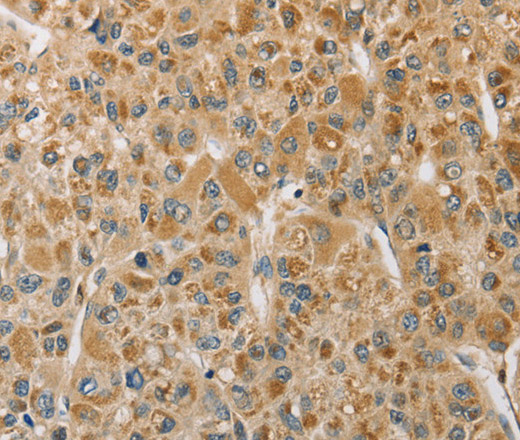 Immunohistochemistry of paraffin-embedded Human liver cancer tissue using MIP Polyclonal Antibody at dilution 1:50