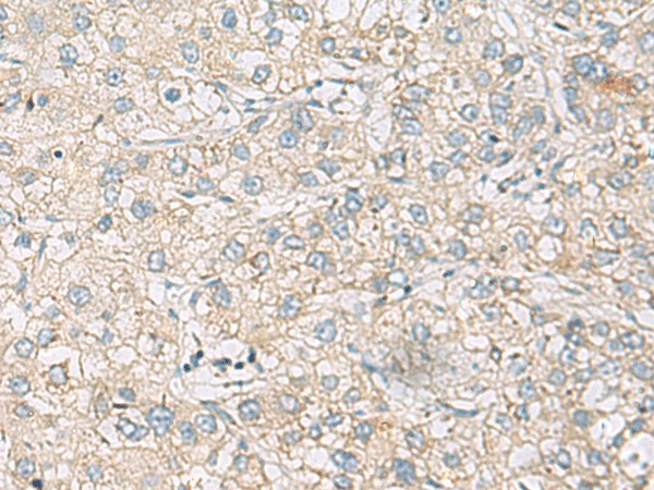 Immunohistochemistry of paraffin-embedded Human liver cancer tissue  using RAC2 Polyclonal Antibody at dilution of 1:60(?200)