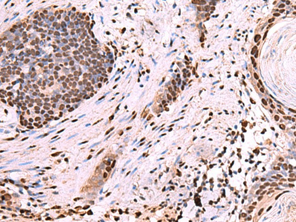 Immunohistochemistry of paraffin-embedded Human esophagus cancer tissue  using NASP Polyclonal Antibody at dilution of 1:60(?200)