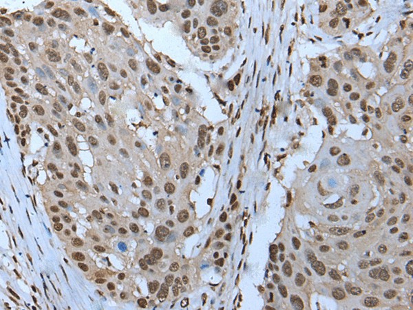 Immunohistochemistry of paraffin-embedded Human esophagus cancer tissue  using ZNHIT3 Polyclonal Antibody at dilution of 1:95(?200)