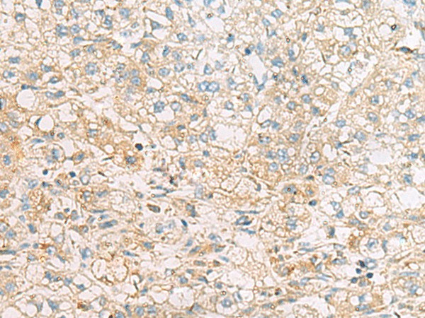 Immunohistochemistry of paraffin-embedded Human liver cancer tissue  using EIF4E2 Polyclonal Antibody at dilution of 1:50(?200)