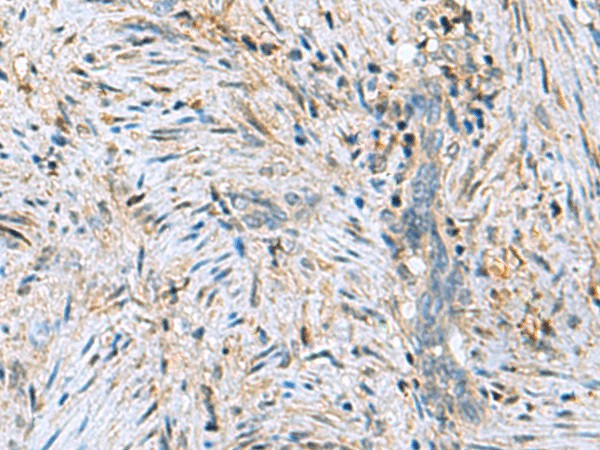 Immunohistochemistry of paraffin-embedded Human cervical cancer tissue  using DNPH1 Polyclonal Antibody at dilution of 1:55(?200)