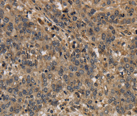 Immunohistochemistry of paraffin-embedded Human liver cancer using KCNN4 Polyclonal Antibody at dilution of 1:40