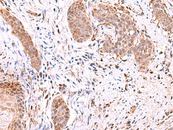 Immunohistochemistry of paraffin-embedded Human esophagus cancer tissue  using RUSC1 Polyclonal Antibody at dilution of 1:90(?200)