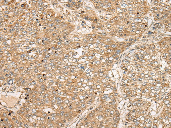 Immunohistochemistry of paraffin-embedded Human liver cancer tissue  using TDGF1 Polyclonal Antibody at dilution of 1:50(?200)