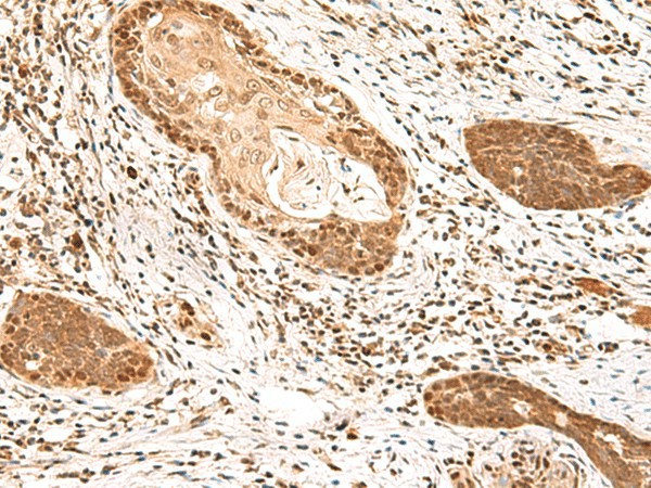 Immunohistochemistry of paraffin-embedded Human esophagus cancer tissue  using MKX Polyclonal Antibody at dilution of 1:60(?200)