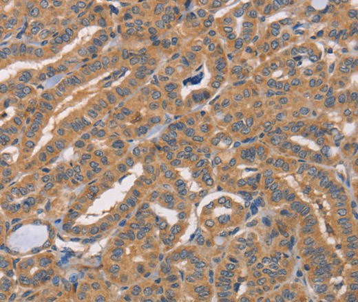 Immunohistochemistry of paraffin-embedded Human thyroid cancer tissue using CDCA4 Polyclonal Antibody at dilution 1:50