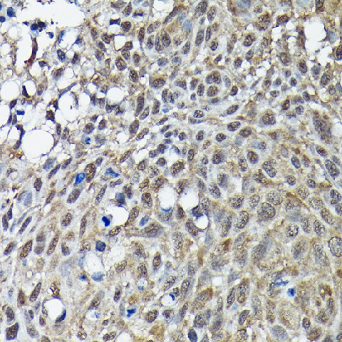 Immunohistochemistry of paraffin-embedded human lung cancer using BRCA1 Polyclonal Antibody at dilution of 1:100 (40x lens).Perform high pressure antigen retrieval with 10 mM citrate buffer pH 6.0 before commencing with IHC staining protocol.