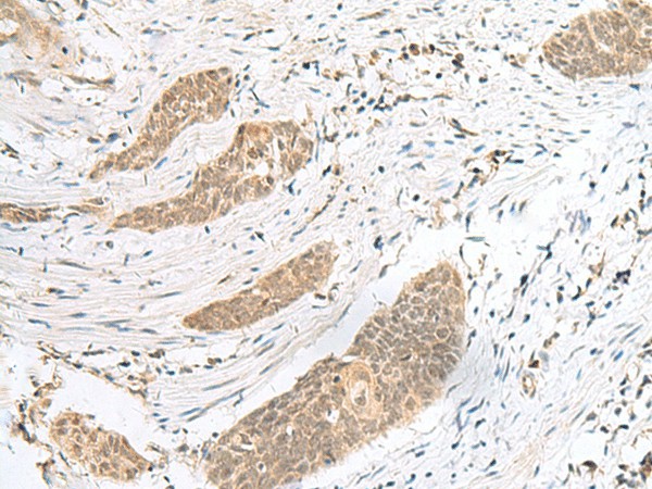 Immunohistochemistry of paraffin-embedded Human esophagus cancer tissue  using ENSA Polyclonal Antibody at dilution of 1:40(?200)