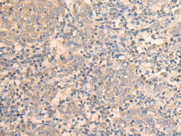 Immunohistochemistry of paraffin-embedded Human cervical cancer tissue  using DAZ1 Polyclonal Antibody at dilution of 1:55(?200)