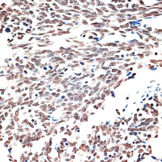 Immunohistochemistry of paraffin-embedded Human lung cancer using AQR Polyclonal Antibody at dilution of  1:100 (40x lens).