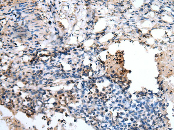 Immunohistochemistry of paraffin-embedded Human lung cancer tissue  using PPP1R15A Polyclonal Antibody at dilution of 1:45(?200)