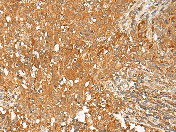 Immunohistochemistry of paraffin-embedded Human cervical cancer tissue  using GPR1 Polyclonal Antibody at dilution of 1:50(?200)