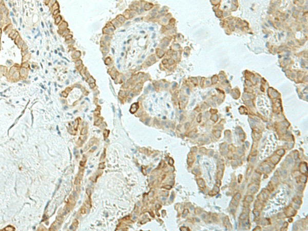 Immunohistochemistry of paraffin-embedded Human thyroid cancer tissue  using ETAA1 Polyclonal Antibody at dilution of 1:25(?200)