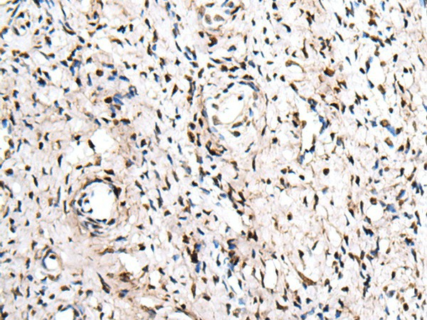 Immunohistochemistry of paraffin-embedded Human cervical cancer tissue  using ZNF207 Polyclonal Antibody at dilution of 1:30(?200)