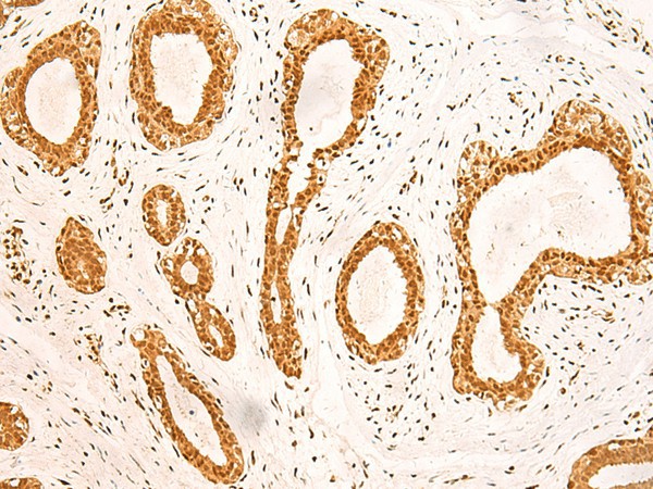 Immunohistochemistry of paraffin-embedded Human breast cancer tissue  using ZNF471 Polyclonal Antibody at dilution of 1:50(?200)