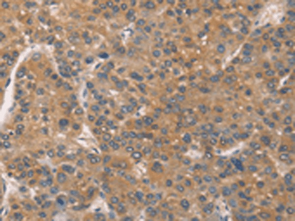 Immunohistochemistry of paraffin-embedded Human liver cancer tissue  using ZADH2 Polyclonal Antibody at dilution of 1:51(?200)